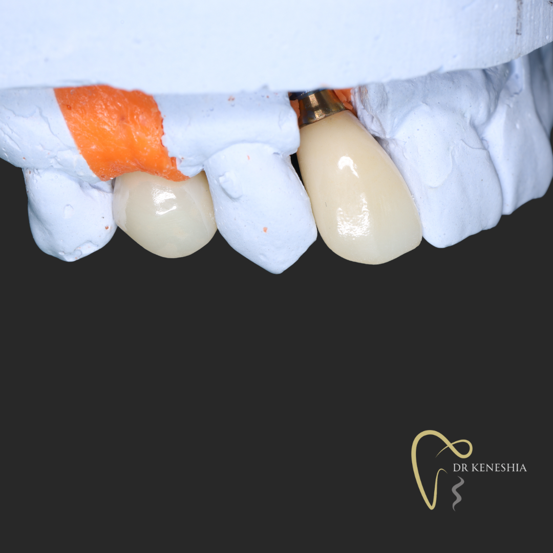 What is a dental implant?